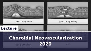 Choroidal Neovascularization 2020 [upl. by Natsyrt739]