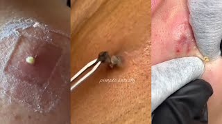 41 Minutes Of Top ASMR Pimple Popping Video [upl. by Sephira]