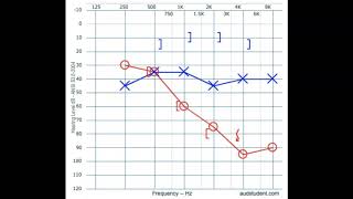 Audiogram interpretation [upl. by Kathleen]