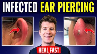 Doctor explains HOW TO RECOGNIZE AND TREAT INFECTED EAR PIERCING [upl. by Madanhoj]