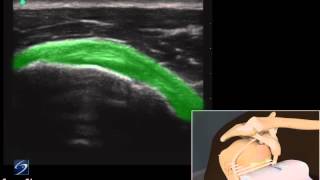 How To Shoulder Subscapularis Tendon 3D Video [upl. by Tteragram]