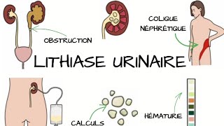 LITHIASE URINAIRE Signes et Symptômes diagnostic traitement  Complications [upl. by Neelra791]