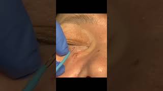 Quick amp Easy Filiform Wart Removal [upl. by Corina]