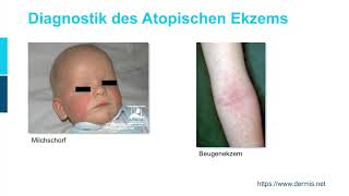 Dermatologie ─ Atopische Dermatitis Teil 12 [upl. by Livvy]