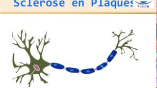 Sclérose en Plaques Physiopathologie Symptomes Diagnostic IRM traitement [upl. by Losyram]