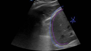 POCUS  Lung Ultrasound Understanding B Lines and Hepatization [upl. by Josee268]