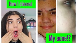 How i cleared my acne amp my experience on lymecycline [upl. by Sorvats812]