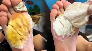 Professional and safe treatment of plantar warts so stressrelieving【 Foot Scalpel】 [upl. by Chao]