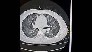 Pneumocystis jirovici pneumonia [upl. by Ratep]