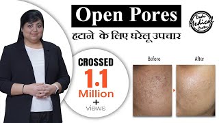 Home Remedies for Open Pores In Hindi  Open Pores Treatment by Dermatologist  Dr Nivedita Dadu [upl. by Annahsat18]