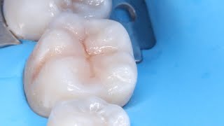 Tips para mejorar tus resinas en los dientes posteriores [upl. by Carole]