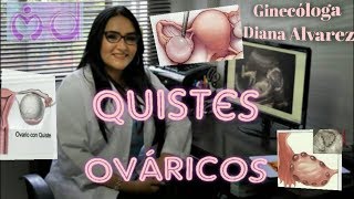 QUISTES OVARICOS POR GINECOLOGA DIANA ALVAREZ [upl. by Anohsal]