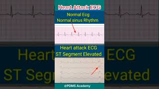 ECG changes During Heart Attack medicine ecg [upl. by Inamik]