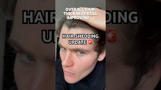 HAIR SHEDDING UPDATE 🚨 hairloss hairline [upl. by Hukill]