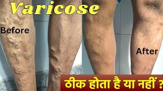 Varicose veins treatment with foam Sclerotherapy and Diode laser Result  varicose veins treatment [upl. by Seiber]