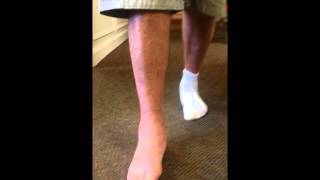 Gait Status Post Triple Arthrodesis Surgery for PTTD Flatfoot SFISM [upl. by Matthias]