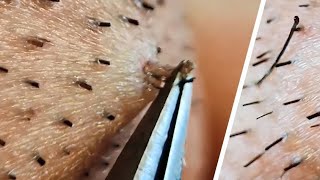 Ingrown hair removal compilation😌 [upl. by Aneeram517]