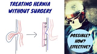 What is Umbilical Hernia Causes Symptoms and Solutions  Dr Parthasarathy shorts [upl. by Berget]