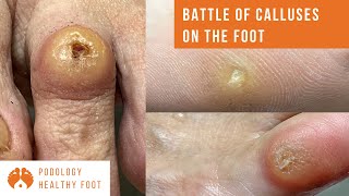 BATTLE OF CALLUSES ON THE FOOT 3 calluses removal on different parts of the foot ASMR podologia [upl. by Madra]