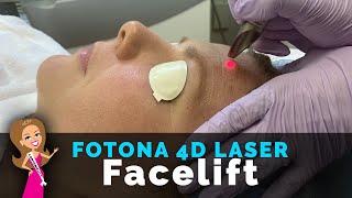 What Does Fotona 4D Laser Feels Like  Laser FACELIFT  Laser Skin Tightening  Build Collagen [upl. by Fitzsimmons]