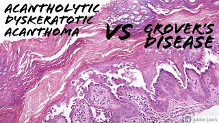 Acantholytic Dyskeratotic Acanthoma vs Grovers Disease 5Minute Pathology Pearls [upl. by Zicarelli164]