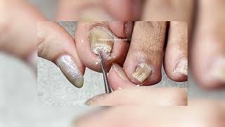 Watch This Clients Pincer Toenail Reversal [upl. by Cooperstein]