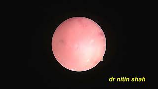 Hysteroscopy for hematometra drainage due to cervical asherman by dr nitin shah [upl. by Wilinski285]