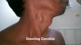 Dancing carotid aortic regurgitation 👇 read description [upl. by Daile]