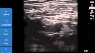 Ultrasoundguided Infraclavicular Brachial Plexus Block [upl. by Nelad575]