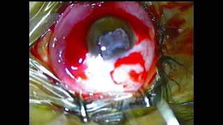 Pterygium operation of MrAmir Hossain [upl. by Rede468]