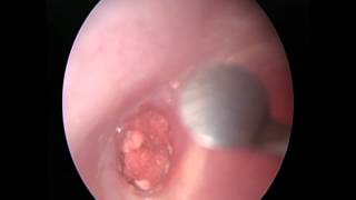 Endoscopic tympanoplasty mediumsized perforation微創中耳炎手術 [upl. by Wier958]