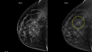 PHYSICS Mammography Procedure 003 [upl. by Adaran10]