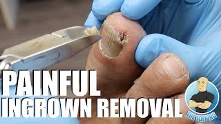 TREATING AN EXTREMELY PAINFUL INGROWN TOENAIL WITH HOW TO ADVICE [upl. by Castle]