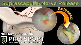 Arthroscopic Suprascapular Nerve Release real surgery  animations [upl. by Ahsele564]