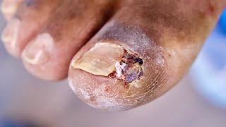 His Last Surgery FAILEDJUICY INFECTED INGROWN TOENAIL [upl. by Akimak]