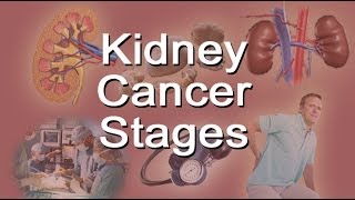 Kidney Cancer Stages [upl. by Hedwig936]