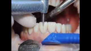 Procera veneers removal [upl. by Neeloc33]