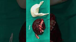 Total Removal of ossifying fibroma with fast expansive growth by eduardoandradebucomaxilo [upl. by December]