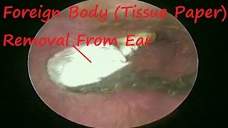 Suffering From Ear Blockage Since 6 Months Itching with Tissue Paper  Got Relief After Procedure [upl. by Ataeb]