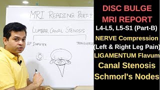 Herniated disc MRI How to read MRI lumbar spine Nerve compression L4L5 L5S1 Canal Stenosis [upl. by Jeniffer]