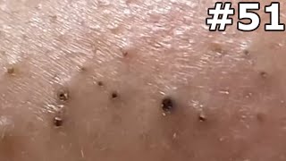 quot🔴 Satisfying Pimple Popping Extravaganza Watch the Most Satisfying Pops Everquot 51 [upl. by Erfert653]