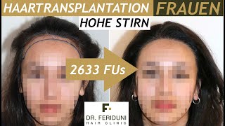 FUE Haartransplantation Frauen  Hohe Stirn amp Geheimratsecken  Vorher Nachher  Haarlinie abgesenkt [upl. by Tepper90]