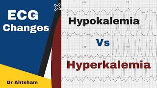 ECG findings Hypokalemia vs Hyperkalemia  Dr Ahtsham [upl. by Ettegdirb914]