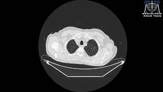 SCANNER THORACIQUE Épanchement pleural gauche responsable d’un collapsus passif du LIG [upl. by Etteragram]