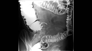 Barium Enema Examinations [upl. by Nylodam238]