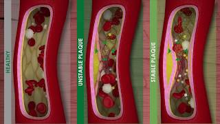 ATHEROSCLEROSIS and CARDIOVASCULAR DISEASE [upl. by Ailuy]