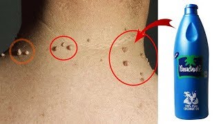 REMOVE SKIN TAG IN 15 DAYS BY APPLYING COCONUT OIL  100 Effective [upl. by Robbyn]