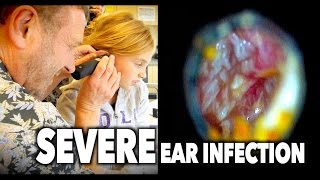 SEVERE DOUBLE EAR INFECTION with pus drainage  Dr Paul [upl. by Lambertson]