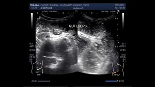 Ultrasound Video showing movements of Bowl contents in Intestinal Obstruction [upl. by Eniamrehc]