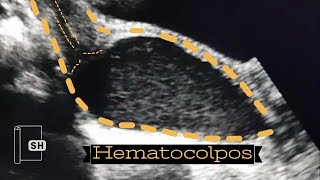 Hematocolpos [upl. by Rohclem]